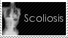 scoliosis