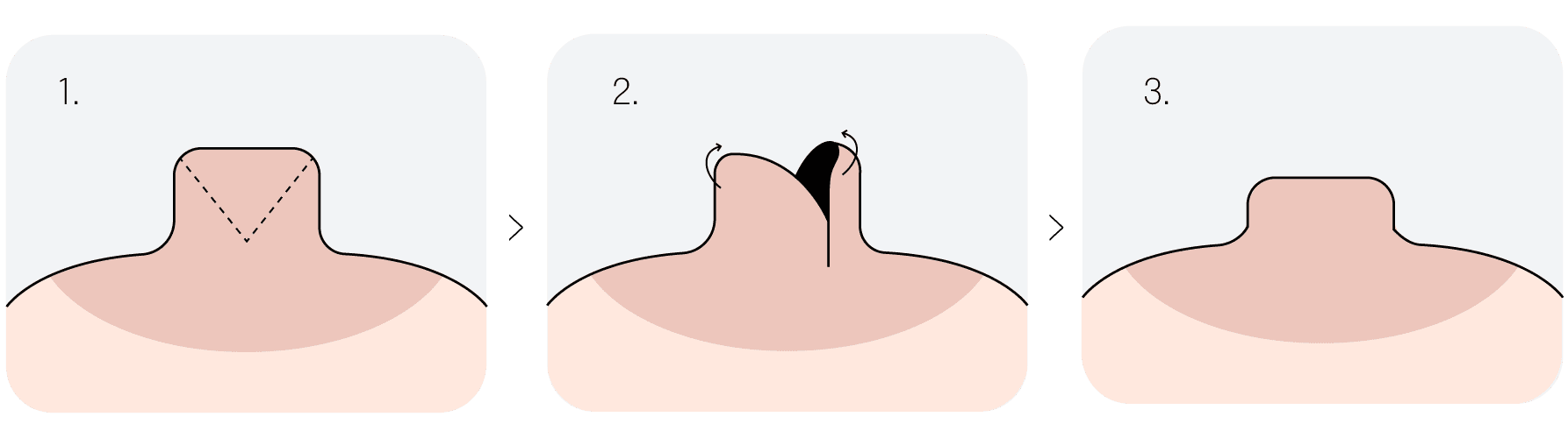 V shape 절제법 예시 비주얼