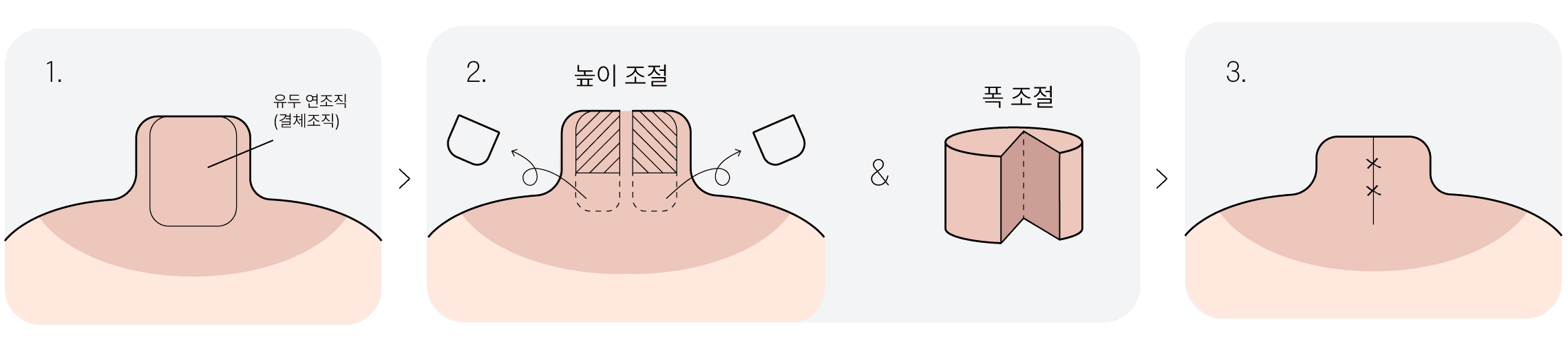 하이유의 유두내부 축소법 예시 비주얼